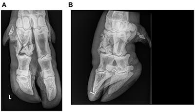 Case Report: Proximal Phalangeal Fracture Management in a European Bison (Bison bonasus)